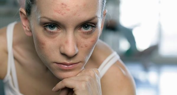 11 Common Causes For Adult Acne And Blemishes