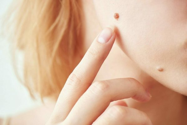 How To Get Rid of Moles on Skin: Is It Safe?